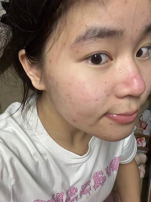 脸上长痘用什么洗脸