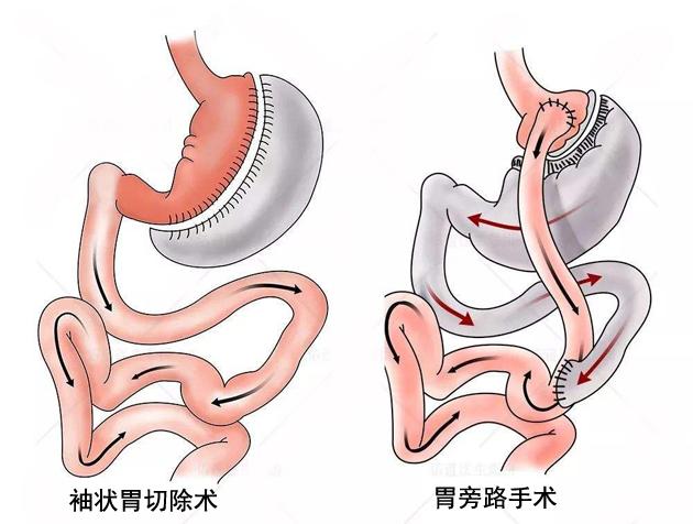 什么样的减肥手术适合你