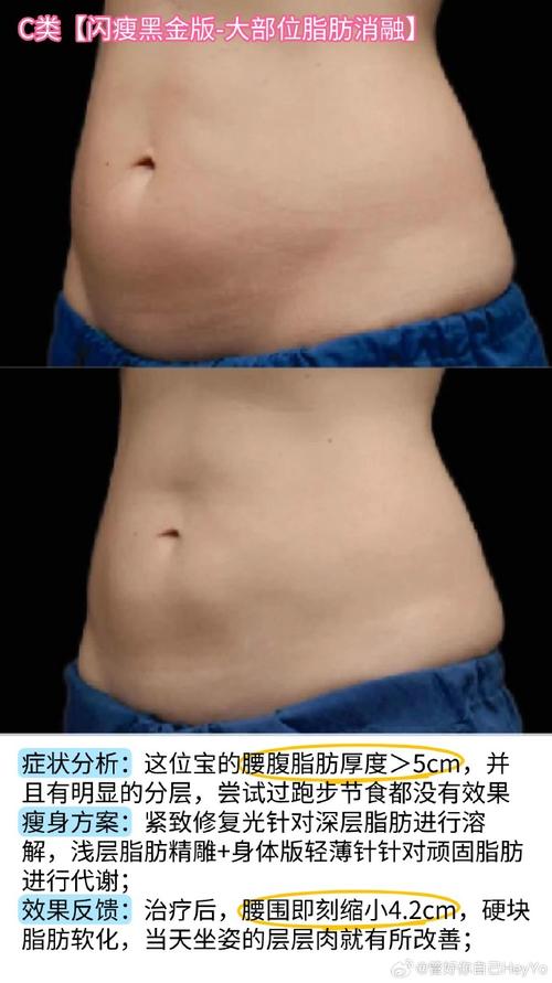 吸脂减肥有什么坏处