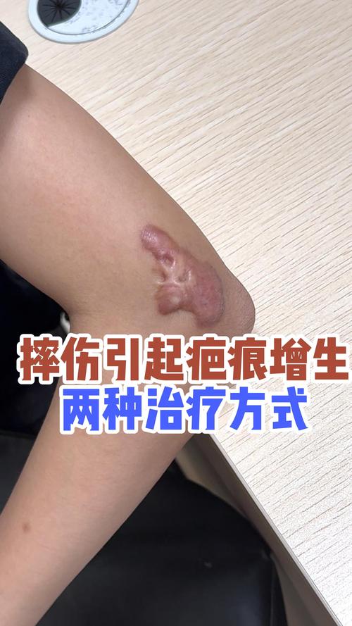 伤疤为什么会增生