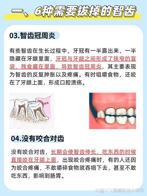 拔智齿有什么危险