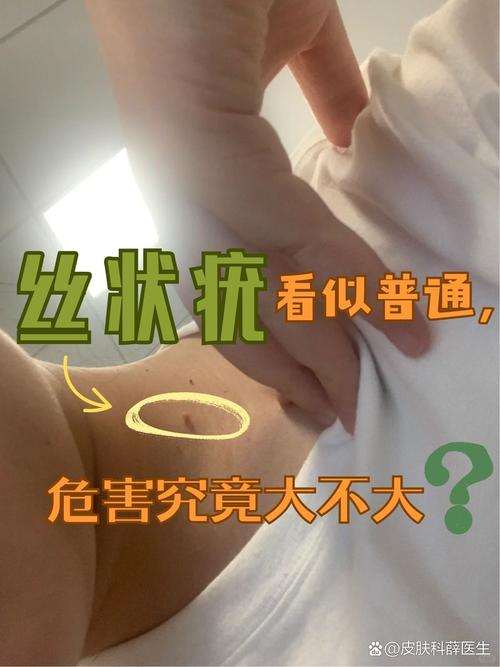 丝状疣是什么病毒