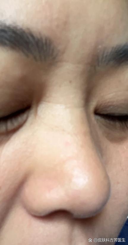 鼻梁有横纹代表什么