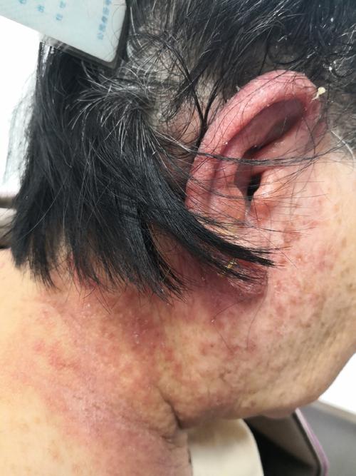 染发过敏什么症状