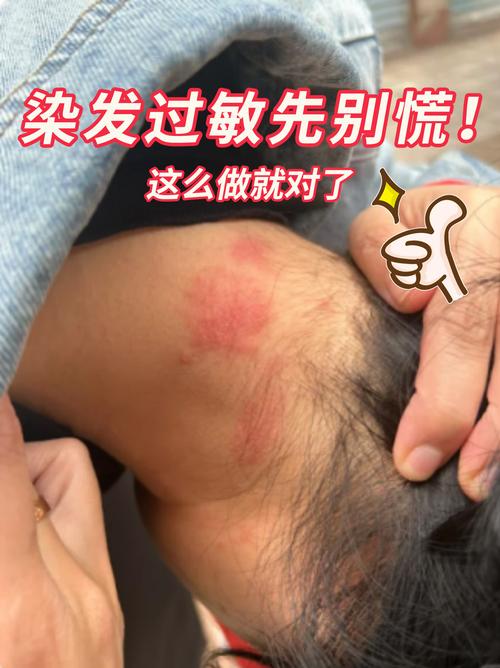 染发过敏什么症状