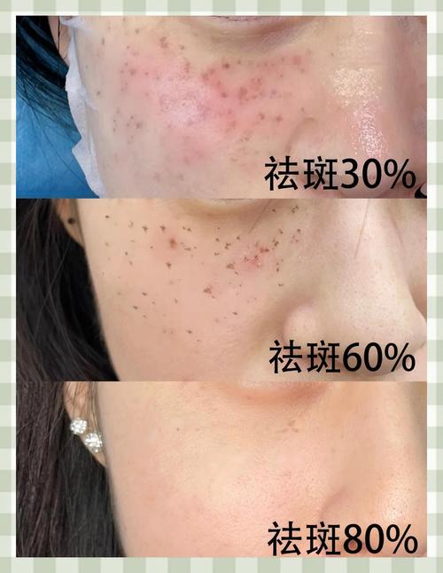 什么是激光去斑