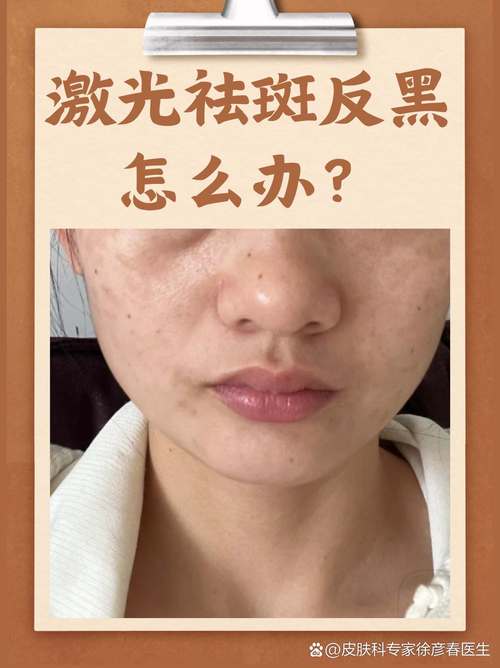 什么是激光去斑