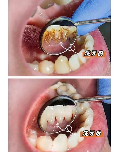 洗牙有什么效果