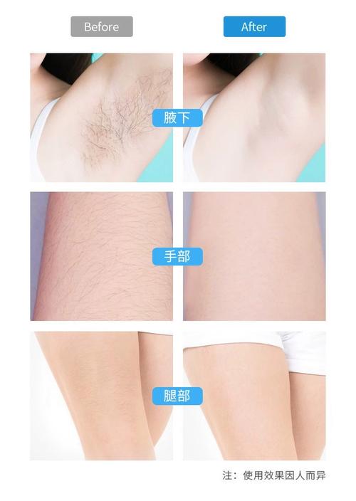 永久脱毛什么最好