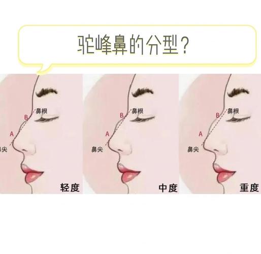 什么是驼峰鼻