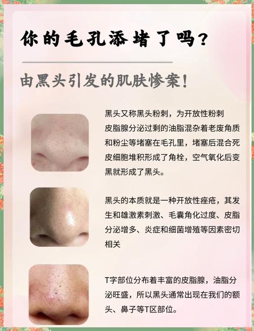 鼻子上为什么长黑头