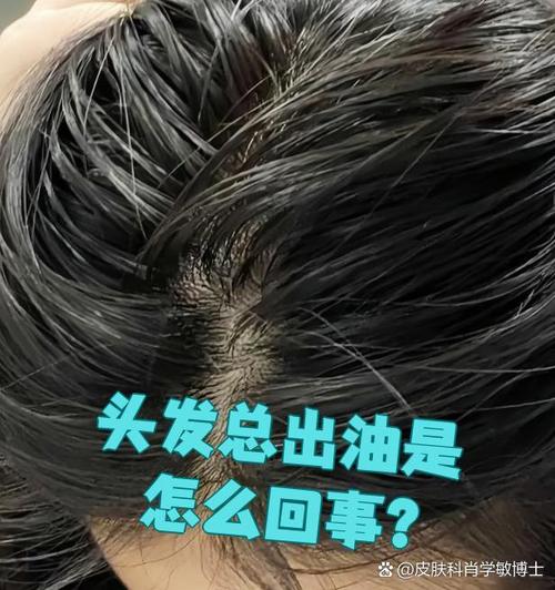 为什么头发总是出油
