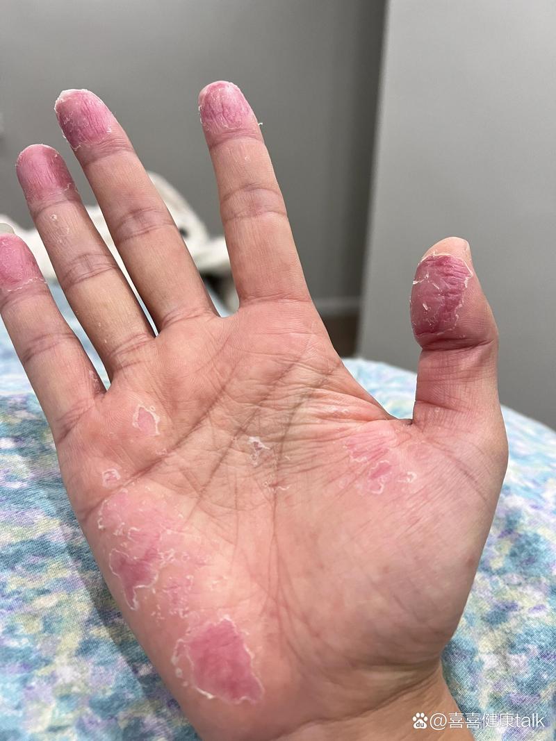 手掌脱皮是缺什么