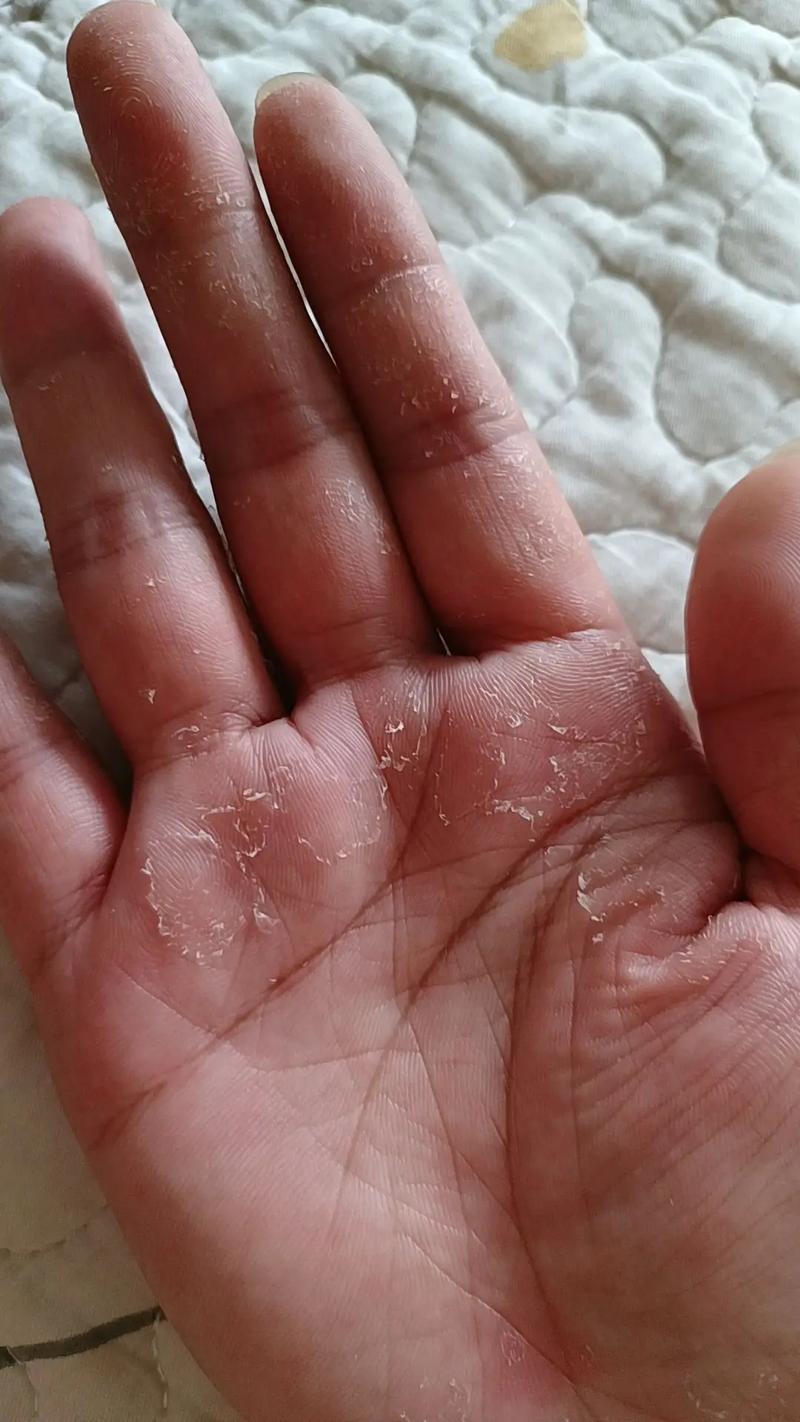 手掌脱皮是缺什么