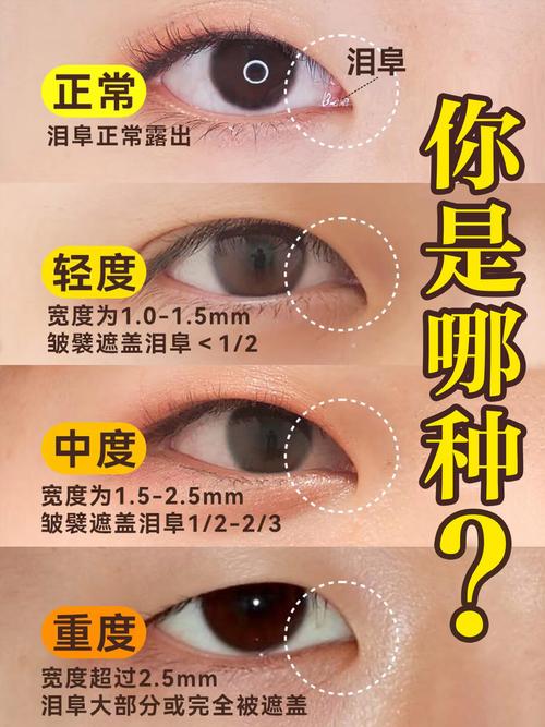 蒙古褶是什么
