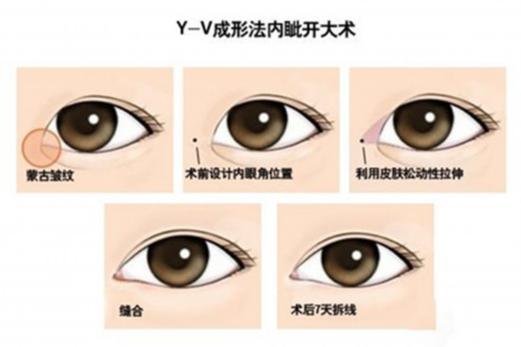 什么内眦