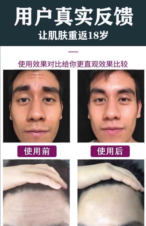 什么除皱纹