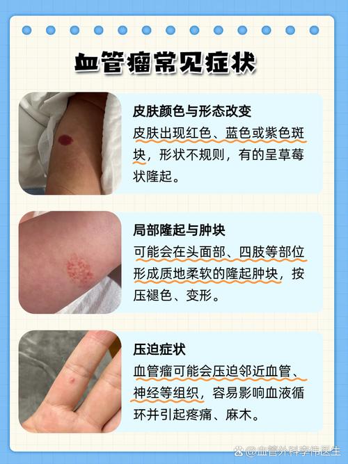 长血管瘤是什么原因
