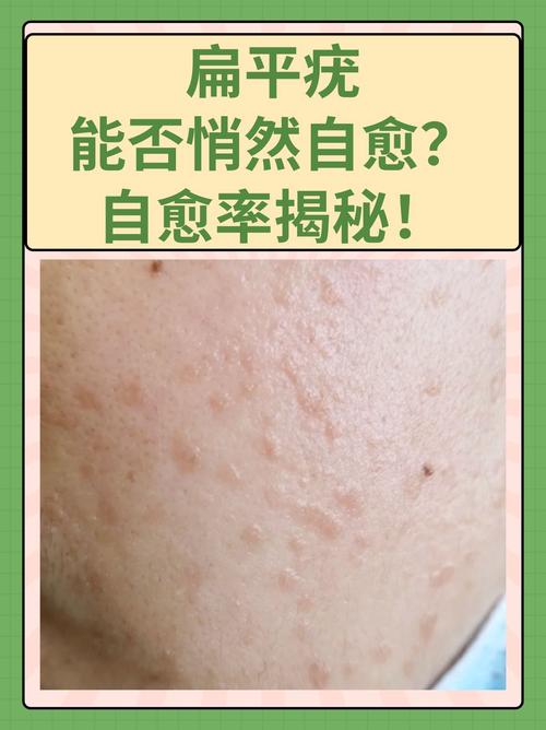 为什么脸上长扁平疣