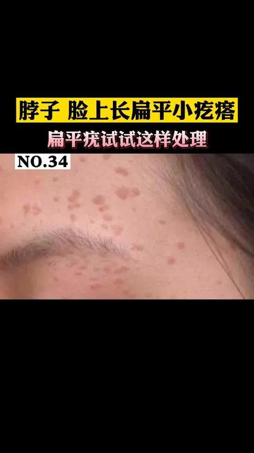为什么脸上长扁平疣