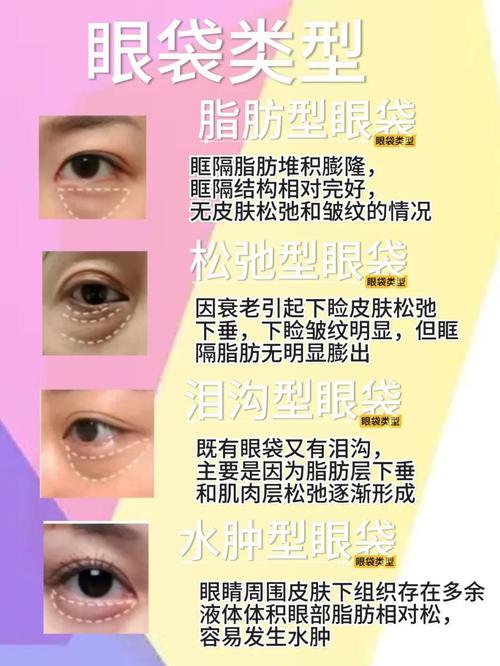 为什么眼袋减肥