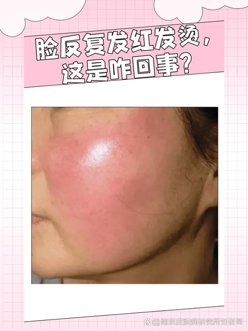 面部发红是什么病