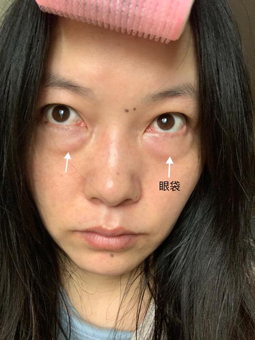 人为什么会有眼袋