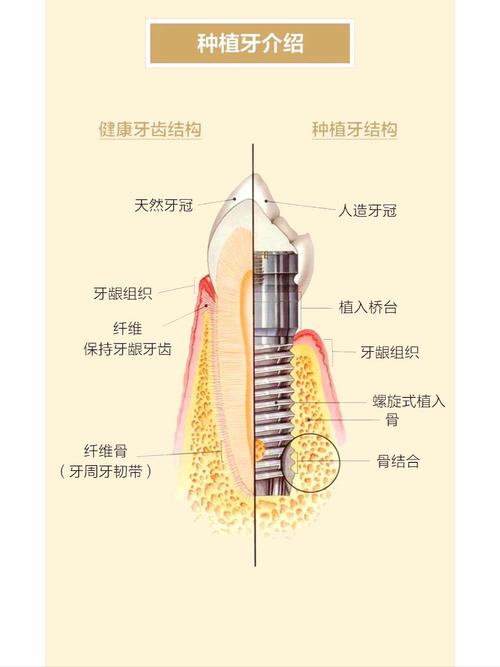 什么情况需要种植牙