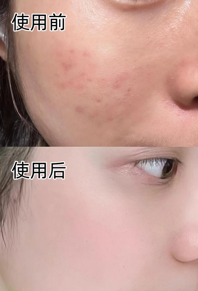刷完酸用了洗面奶会怎么样
