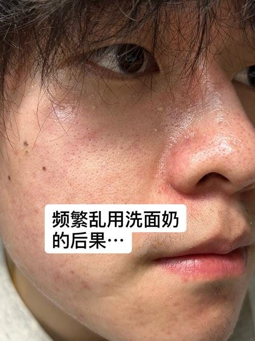 用洗面奶脸发红发烫怎么回事