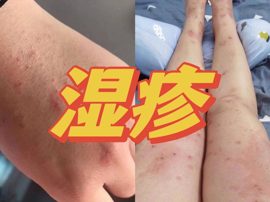 什么是慢性湿疹