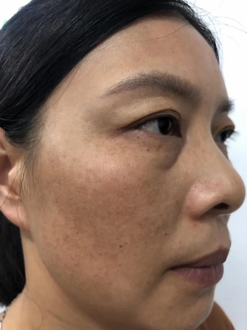 什么是母斑