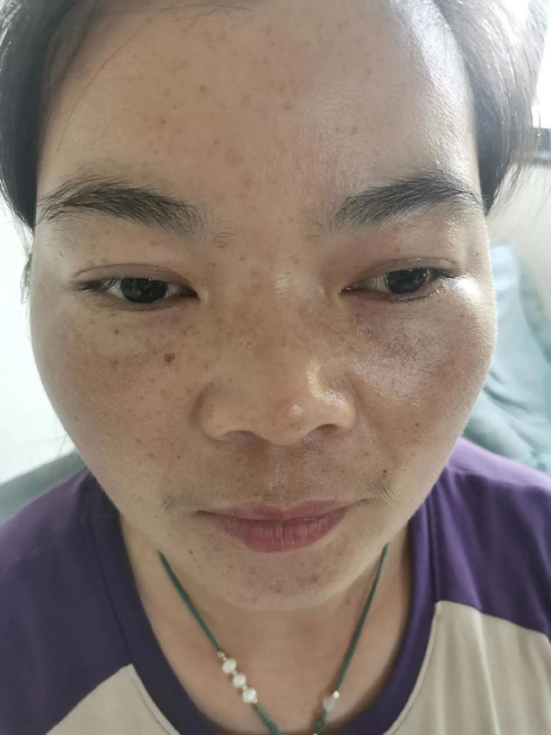 什么是母斑