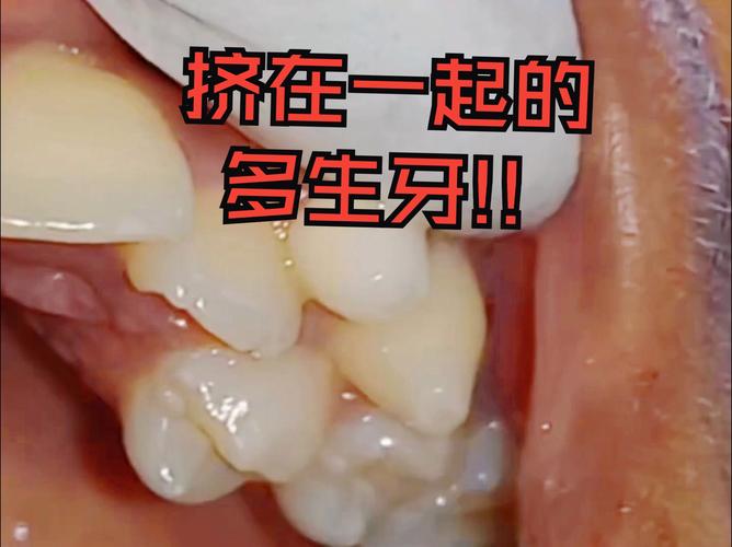 什么是多牙