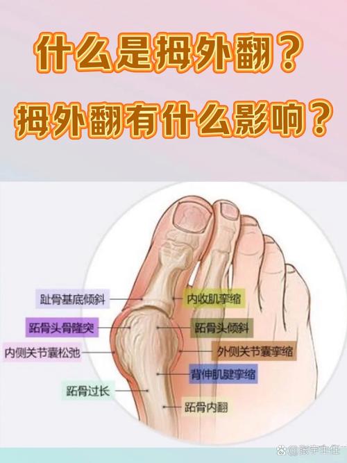 什么是大脚骨
