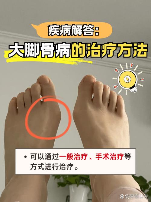 什么是大脚骨