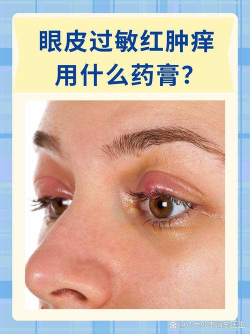过敏涂什么好