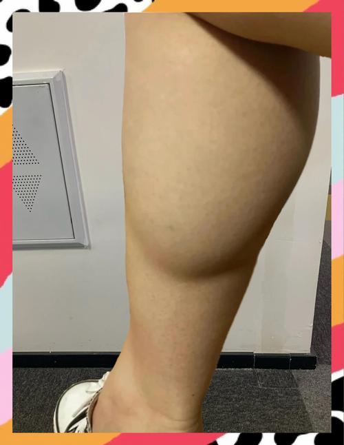 什么是脂肪腿