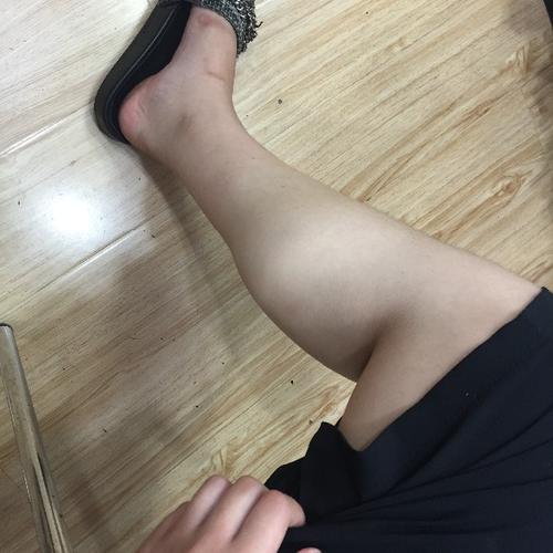 什么是脂肪腿