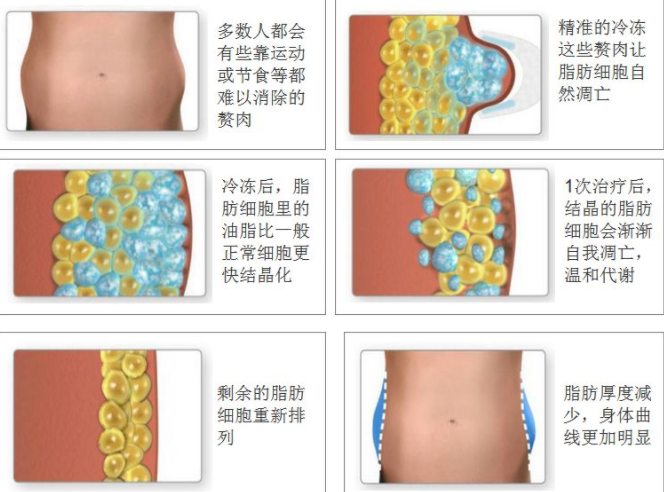 什么是冷冻溶脂减肥