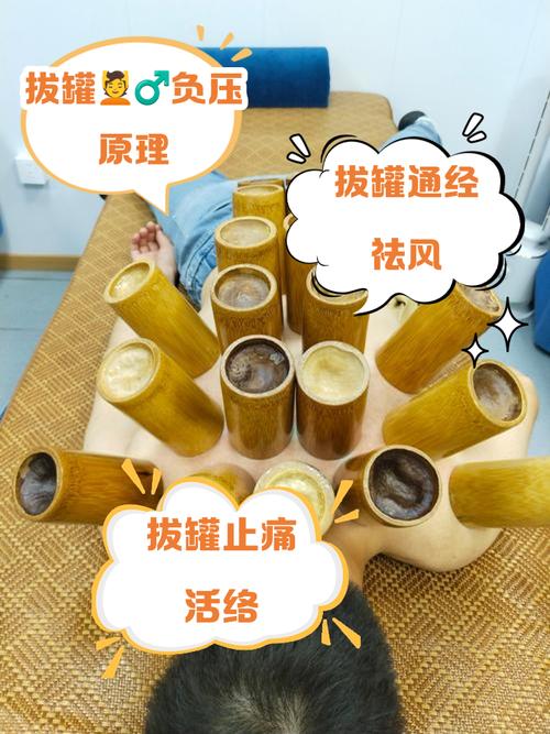 针灸拔罐减肥原理是什么意思