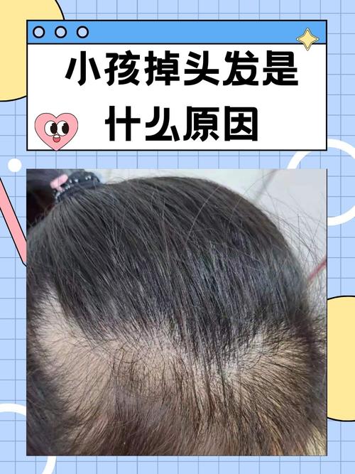 为什么会突然掉头发
