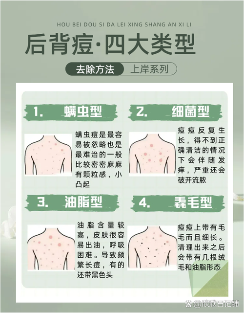为什么背上会长痘痘