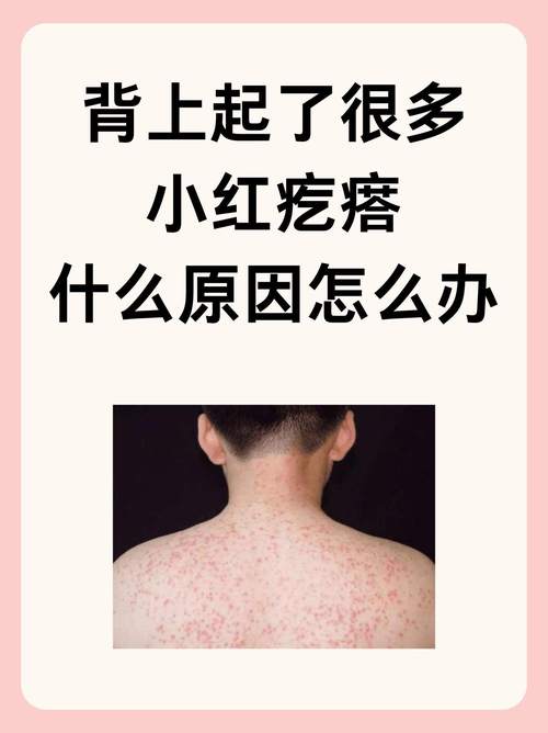 为什么背上会长痘痘