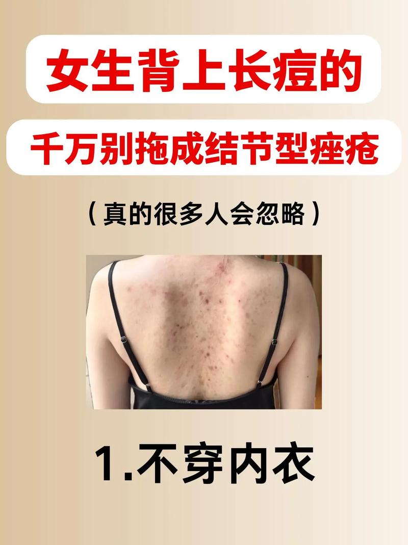 为什么背上会长痘痘