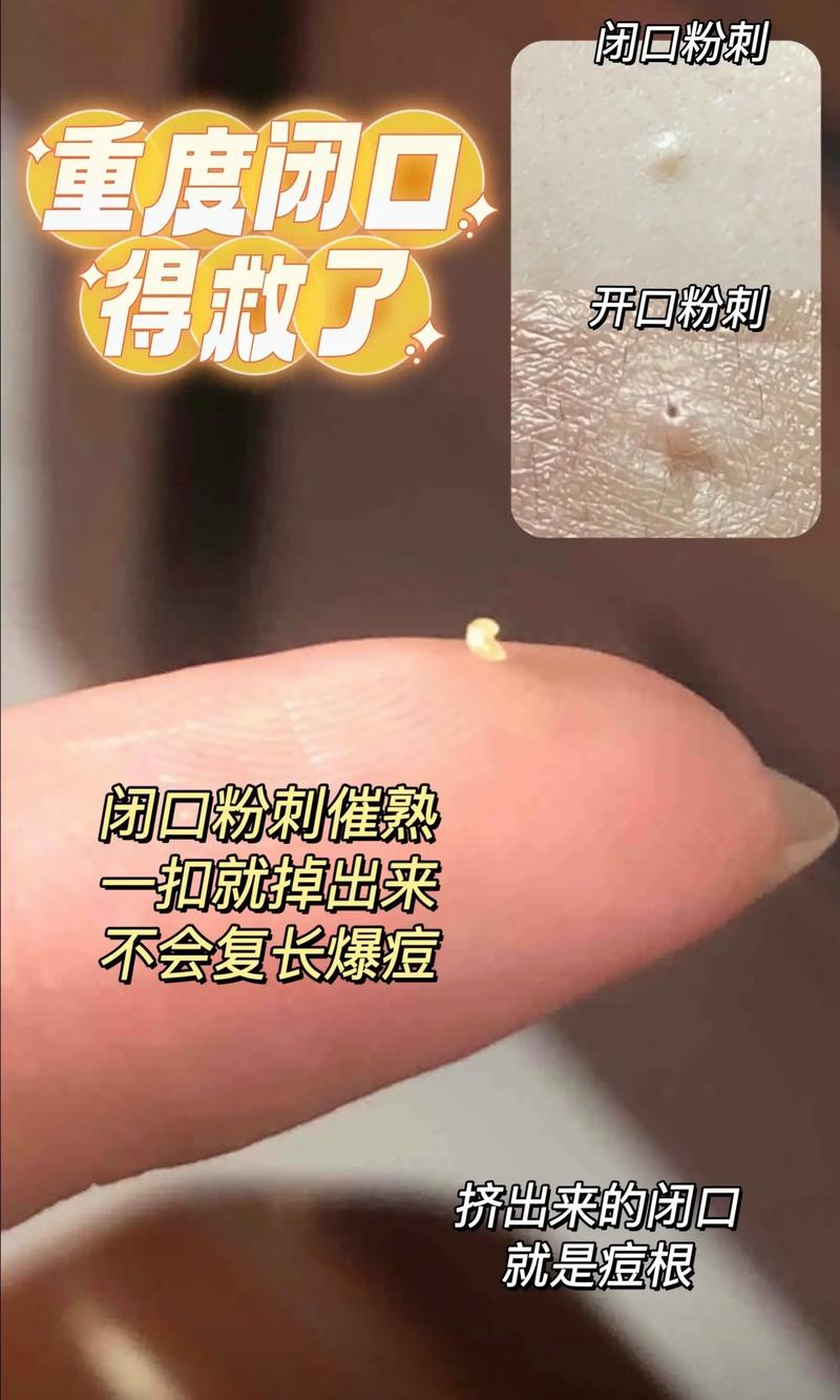 长闭口粉刺是什么原因
