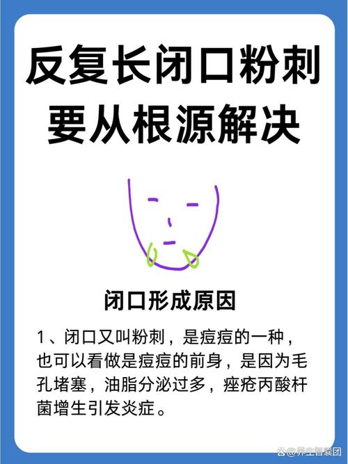 长闭口粉刺是什么原因