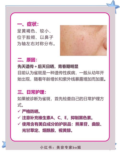 脸上长雀斑什么原因