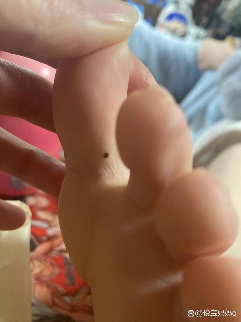 脚趾缝有痣代表什么