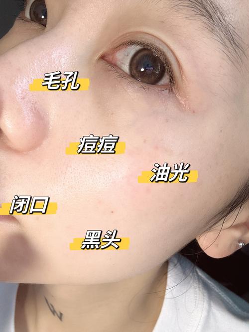 洗面奶洗的脸上起痘痘怎么回事